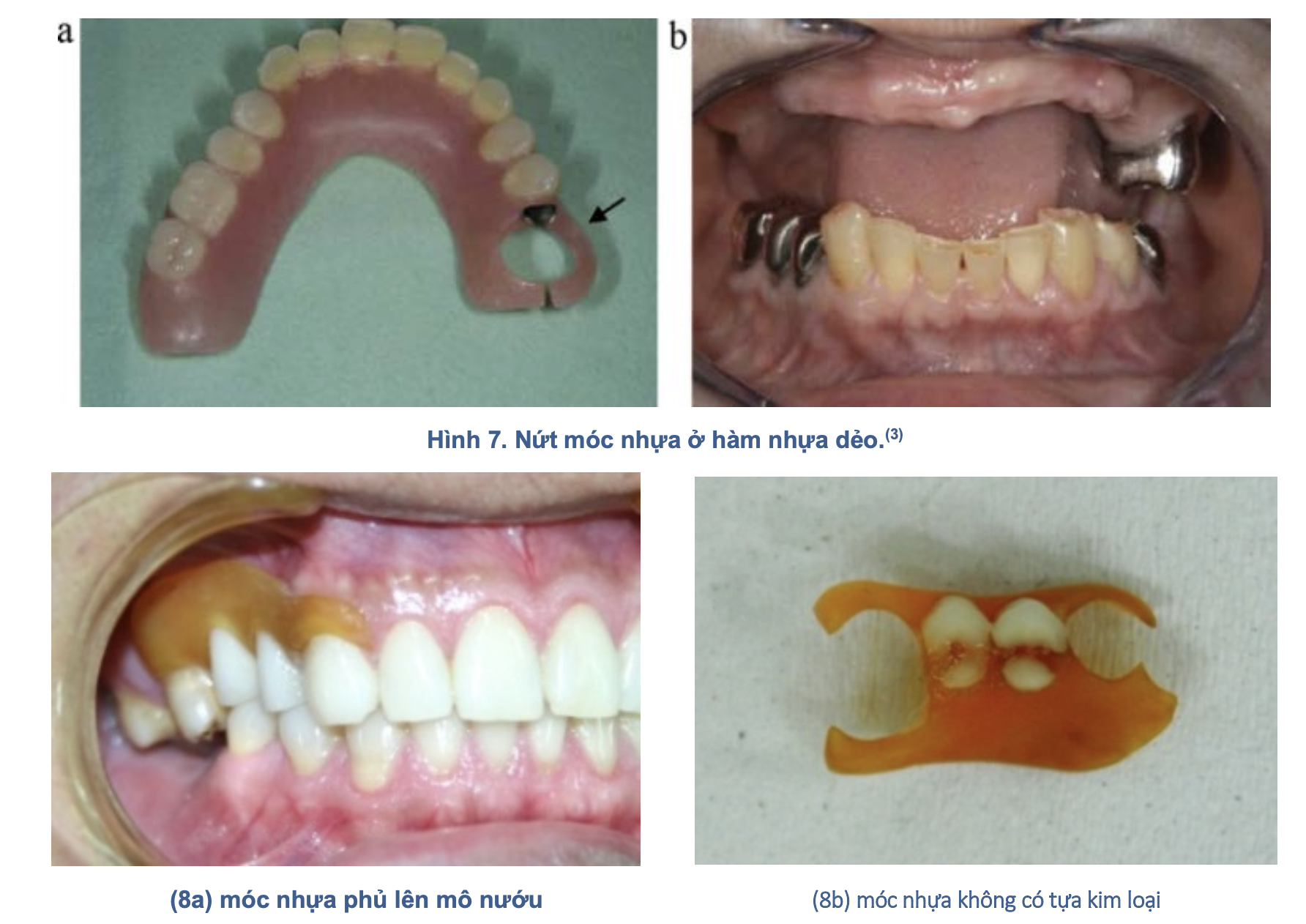 Hàm nhựa dẻo trong phục hình tháo lắp: Đặc tính, chỉ định và biến chứng lâm sàng